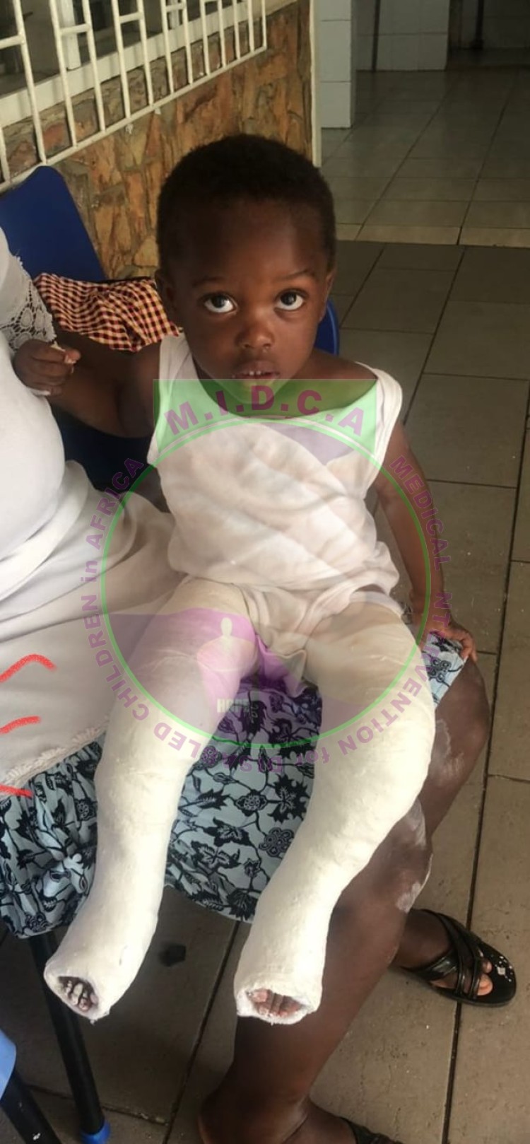 William Bilateral Club Foot