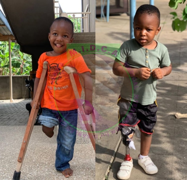 David Prosthetic leg