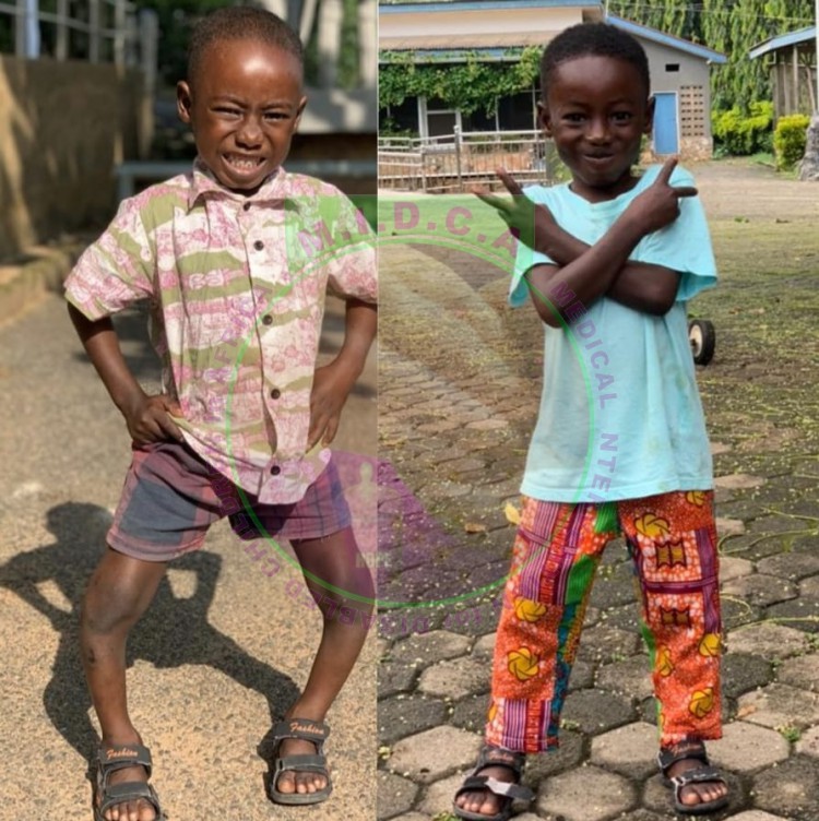 Adom Bilateral Bowed Legs