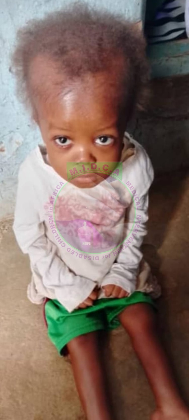 Hydrocephalus fluid in the brain