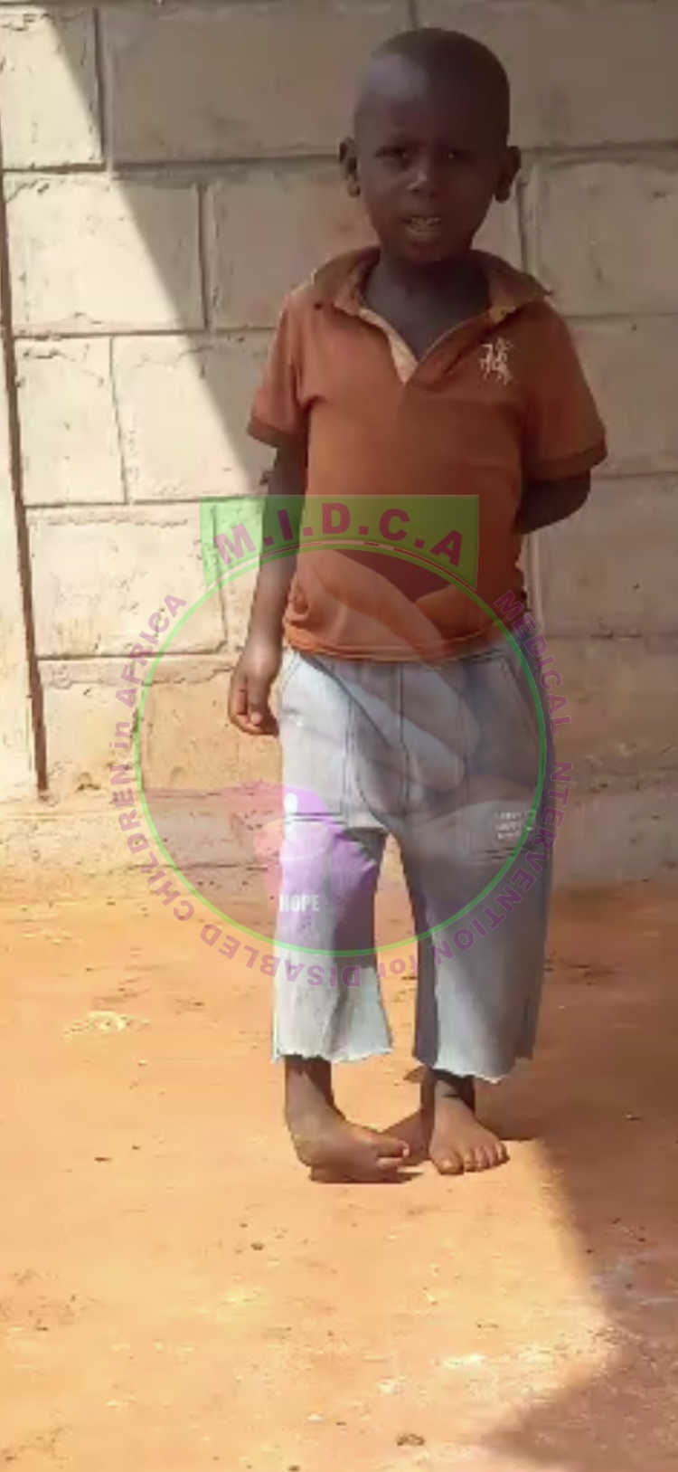 Abdurahman Club Foot