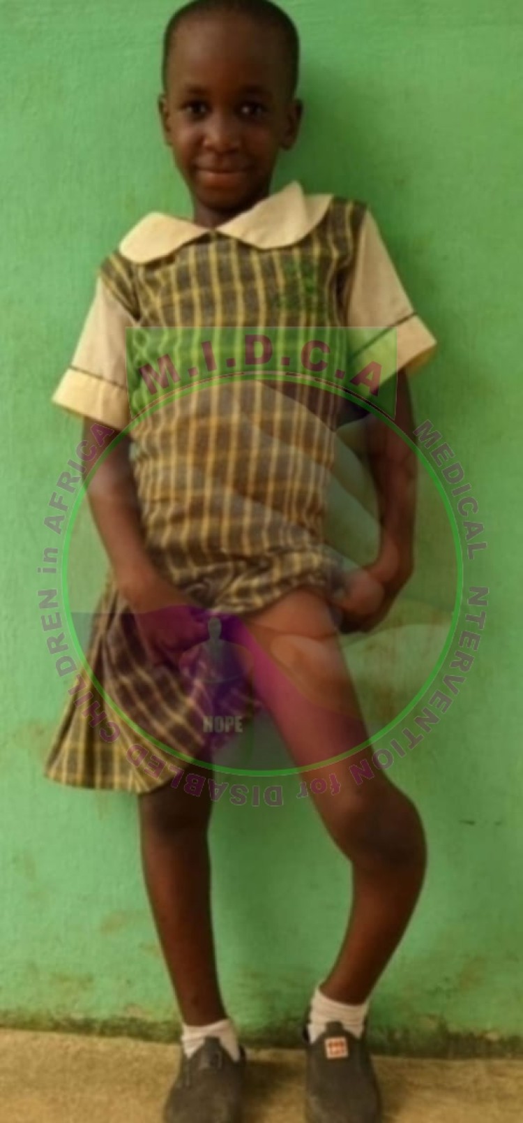 Justina Leg Deformity