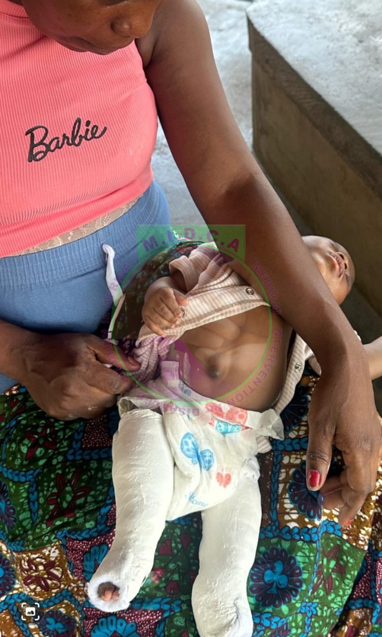 Elizabeth Bilateral Clubfoot