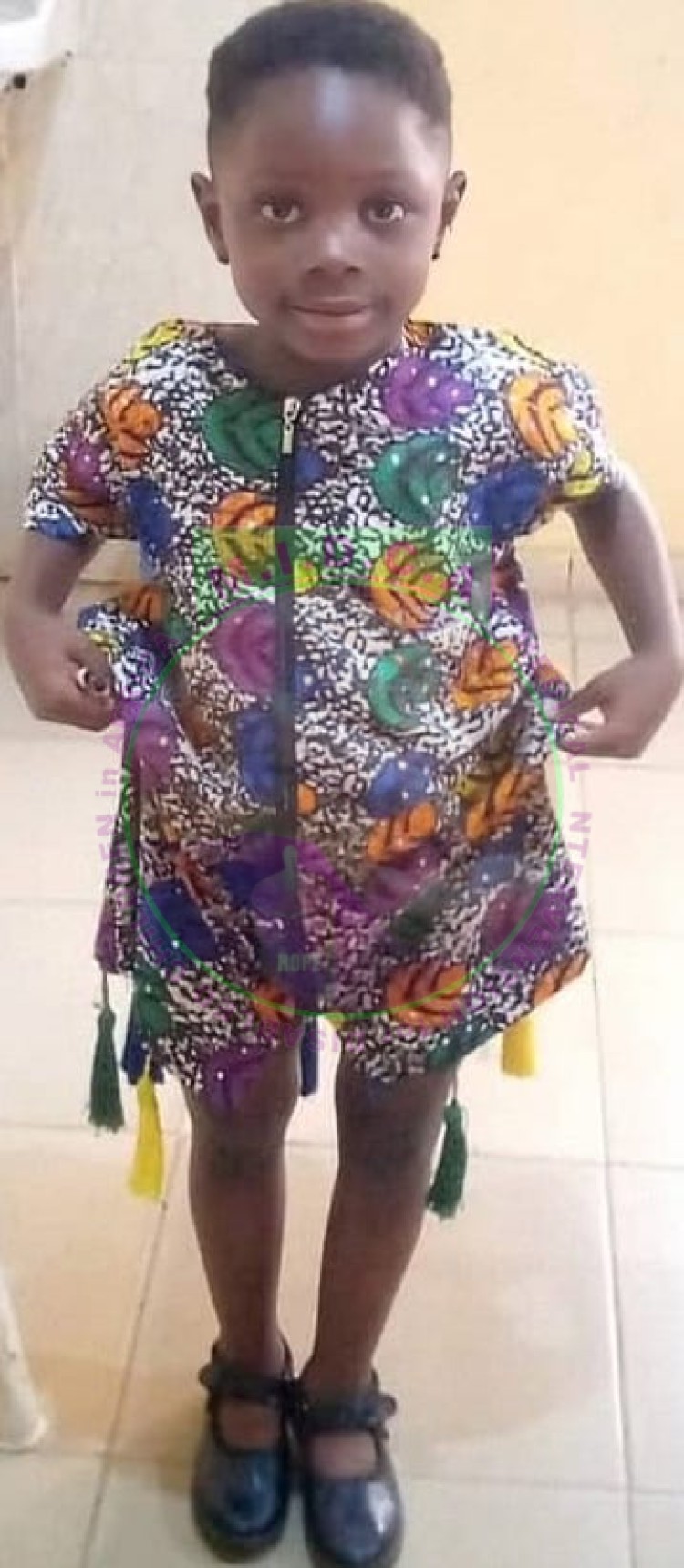 Rodiat Windswept Deformity