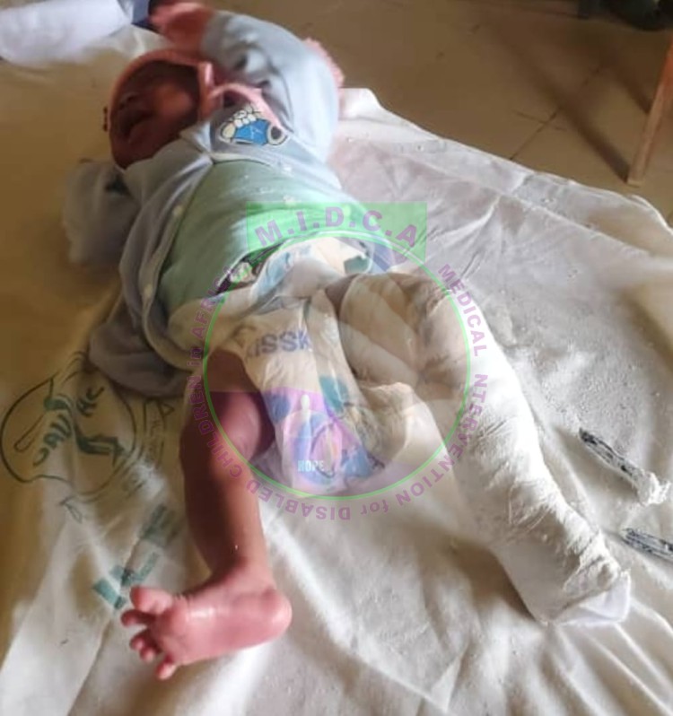 Gbadebo Left Unilateral Club Foot