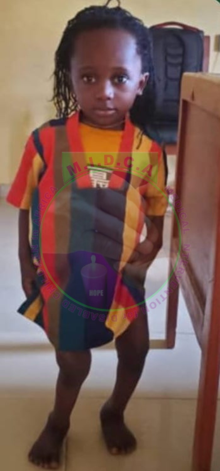 Emmanuel Windswept Deformity