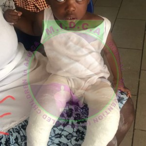 William Bilateral Club Foot