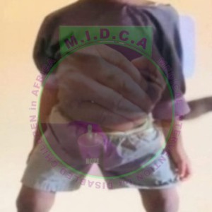 Mercy Bowed Leg Correction