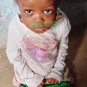 Hydrocephalus fluid in the brain