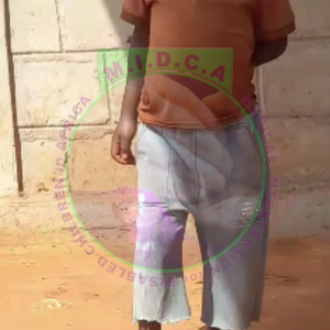 Abdurahman Club Foot