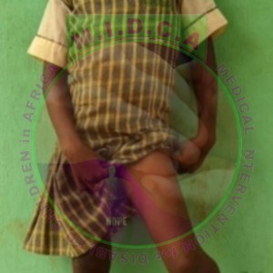 Justina Leg Deformity