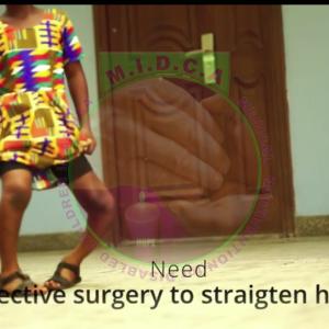 Emmanuella Bilateral Bowed Leg