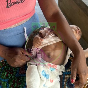 Elizabeth Bilateral Clubfoot