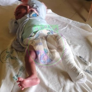 Gbadebo Left Unilateral Club Foot